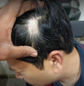 Raghav's Homeopathy, One of the Best Homeopathy Clinic in HSR Layout Bangalore Hair Loss Permanent Treament